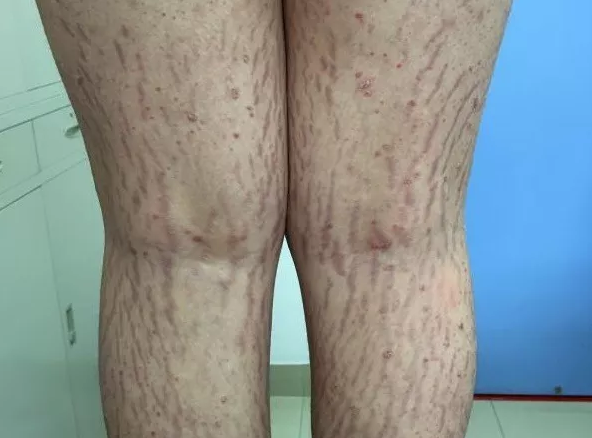 后悔!5岁女儿浑身长黑毛,遍布红斑,就因妈妈做了这事