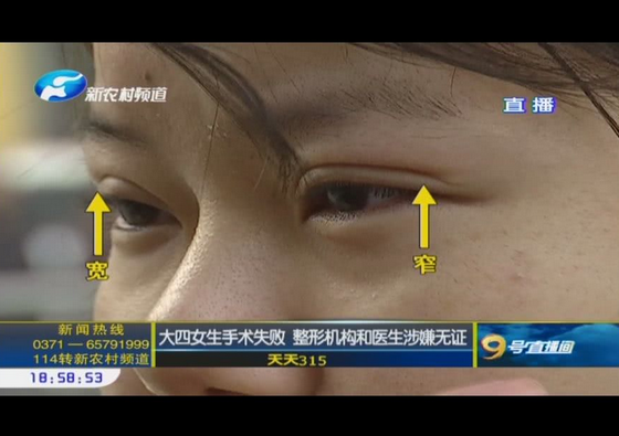 洛阳女生整形失败三个月不敢出门