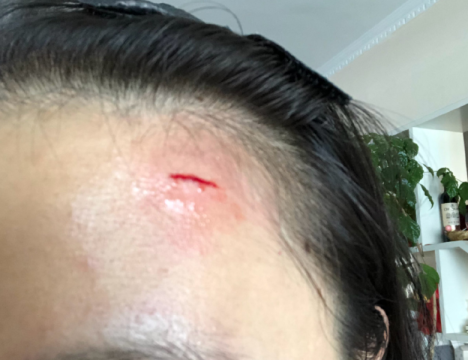 奇葩!宽一米的人行道上线杆垃圾桶扎堆 郑州一市民额头碰伤