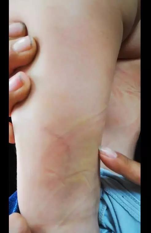 三岁男童长期遭继母拳打,嘴咬……全身上下伤痕累累!