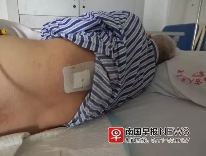 男子做右肾取石手术医生竟左右不分切左肾