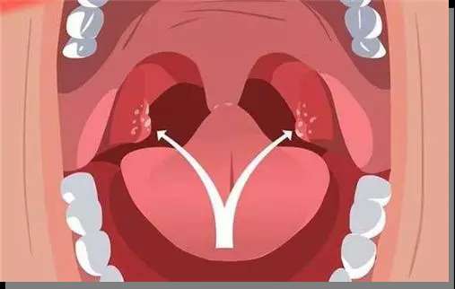 有口气 可能是你嘴里长了 小石头 大河报网