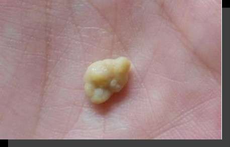 那么,面对自己的口臭问题,如何才能分辨出是扁桃体结石在背后捣鬼呢?