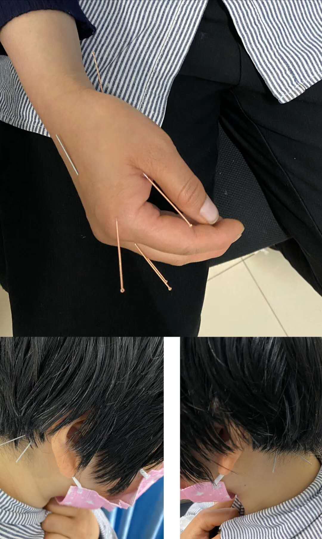 失眠焦虑抑郁不妨试试针灸